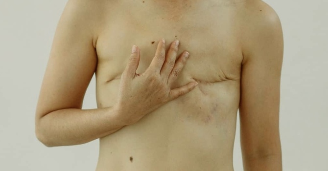 Breast Oncology Massage